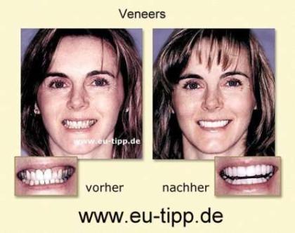 ZAHN-Behandlung CZ - Implantate ab Euro 490